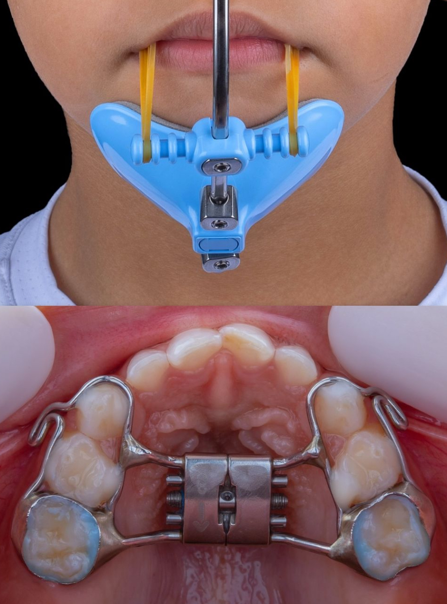 Maschera facciale per copricapo ortodontico dentale con leva singola