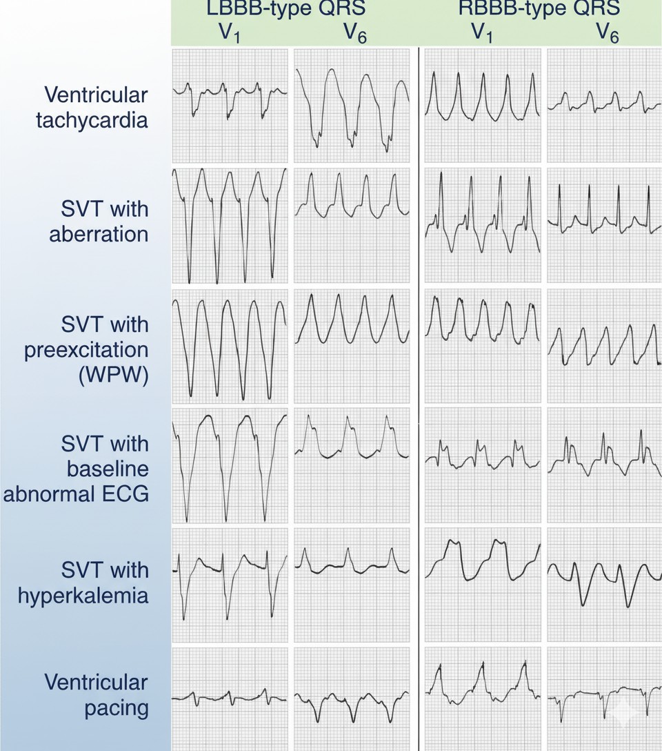 Supraventricular tachycardia vs ventricular tachycardia key