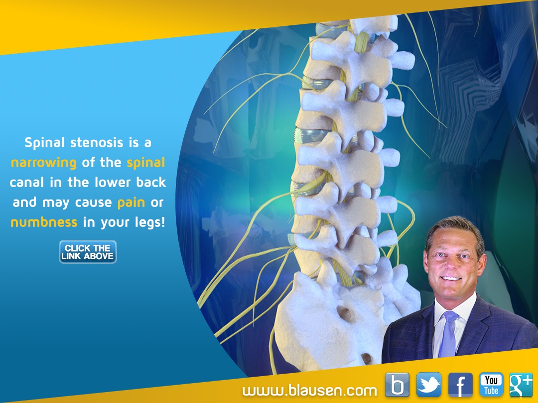 Blausen - What is Spinal Stenosis? | '#Spinalstenosis is a condition ...