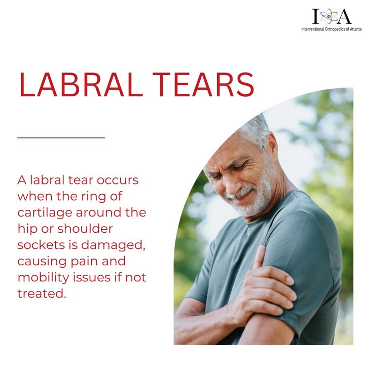 labrum tear bpc 157 hip Labral Recovery Without Surgery Can I Recover from a bpc 157 labrum tear bpc