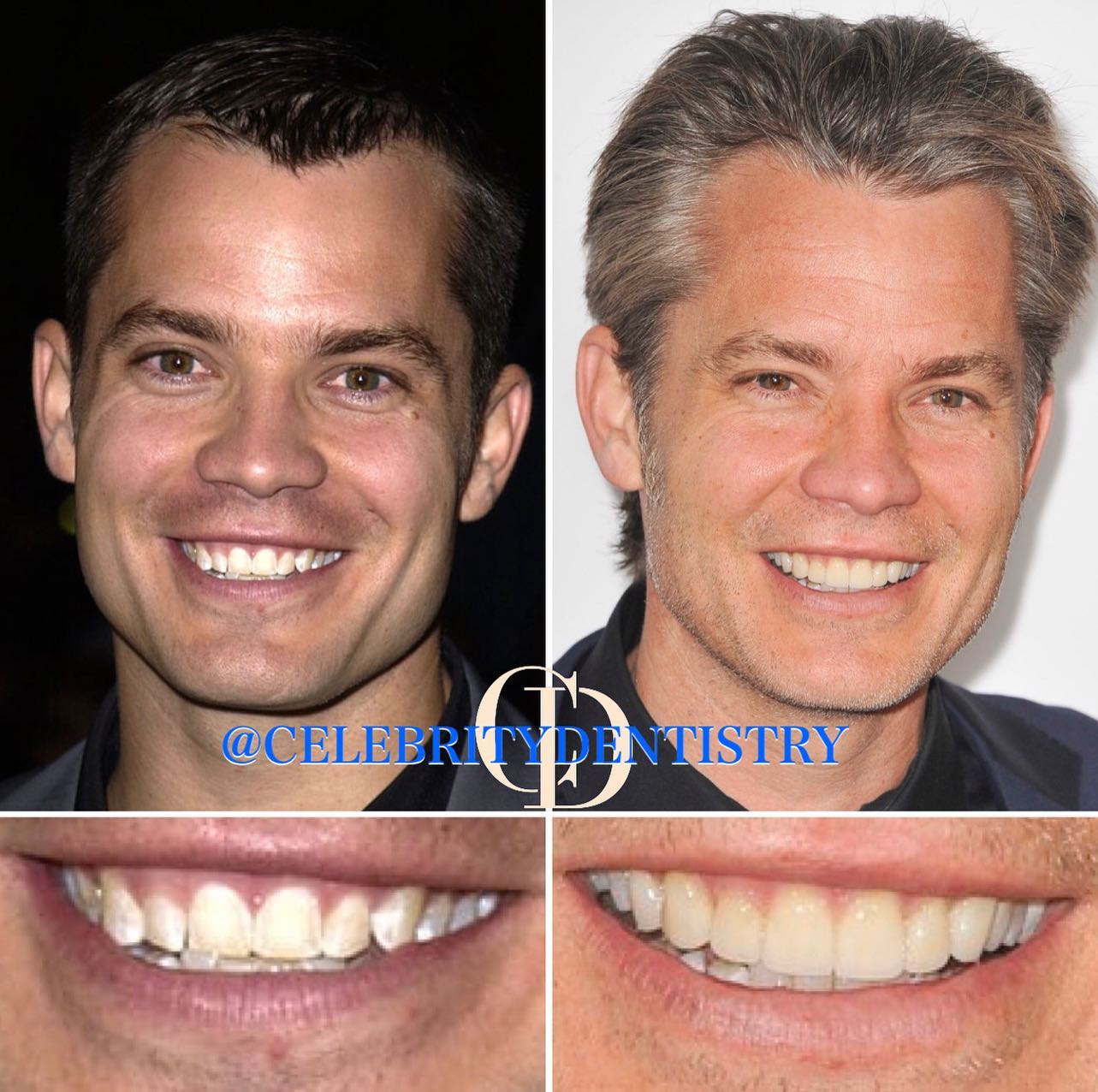 CelebrityDentistry - Timothy Olyphant’s Smile Makeover #timothyolyphant ...