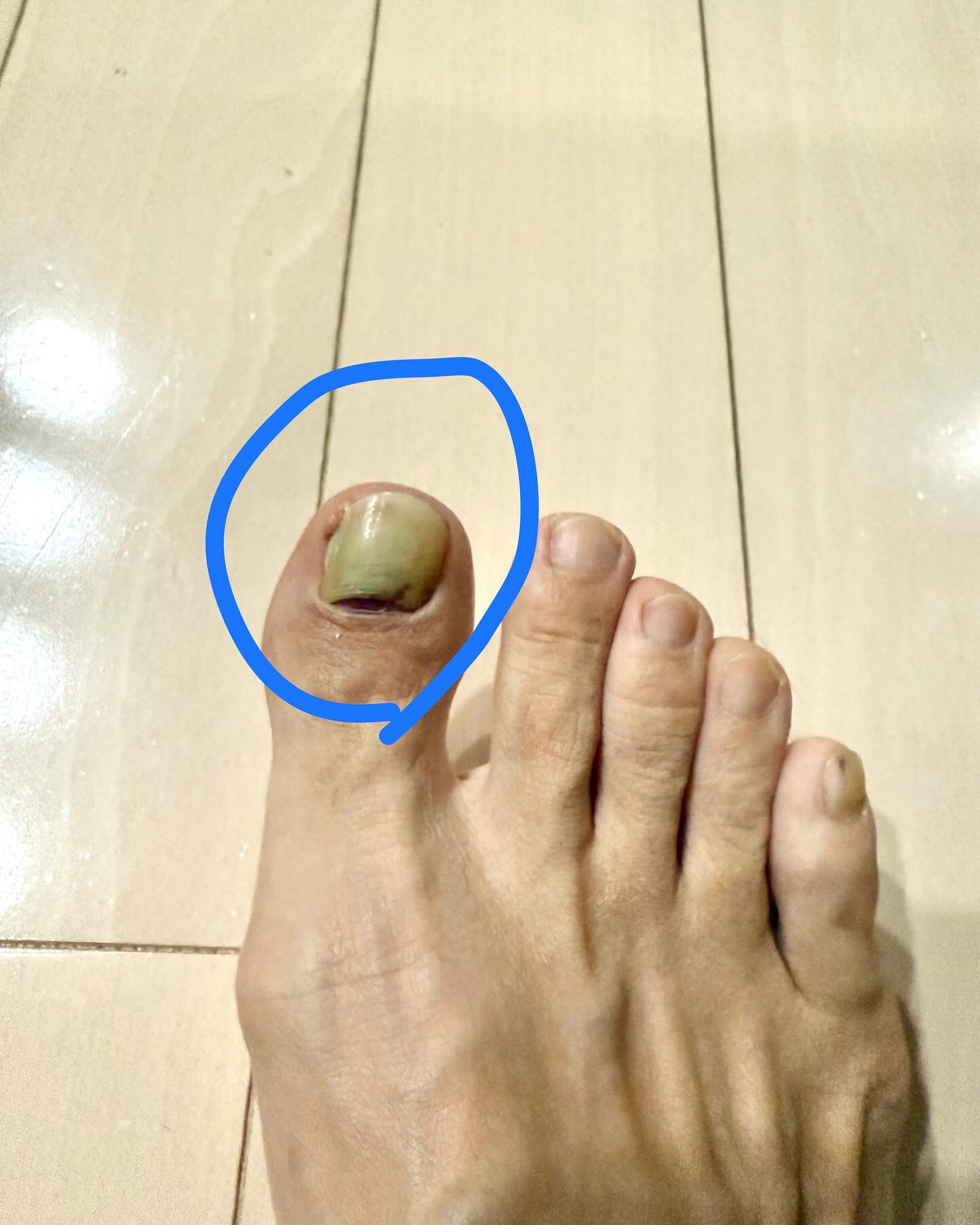 足 親指 爪 内出血