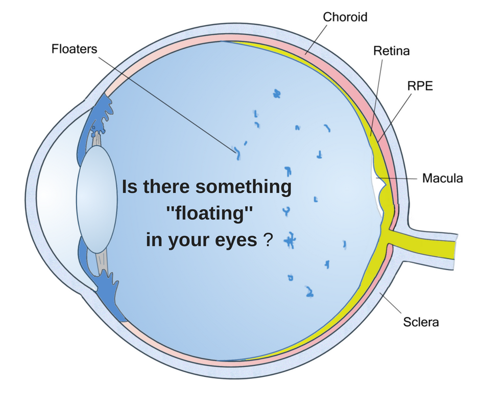 What are floaters? What do they look... - Shire Optometrists | Facebook