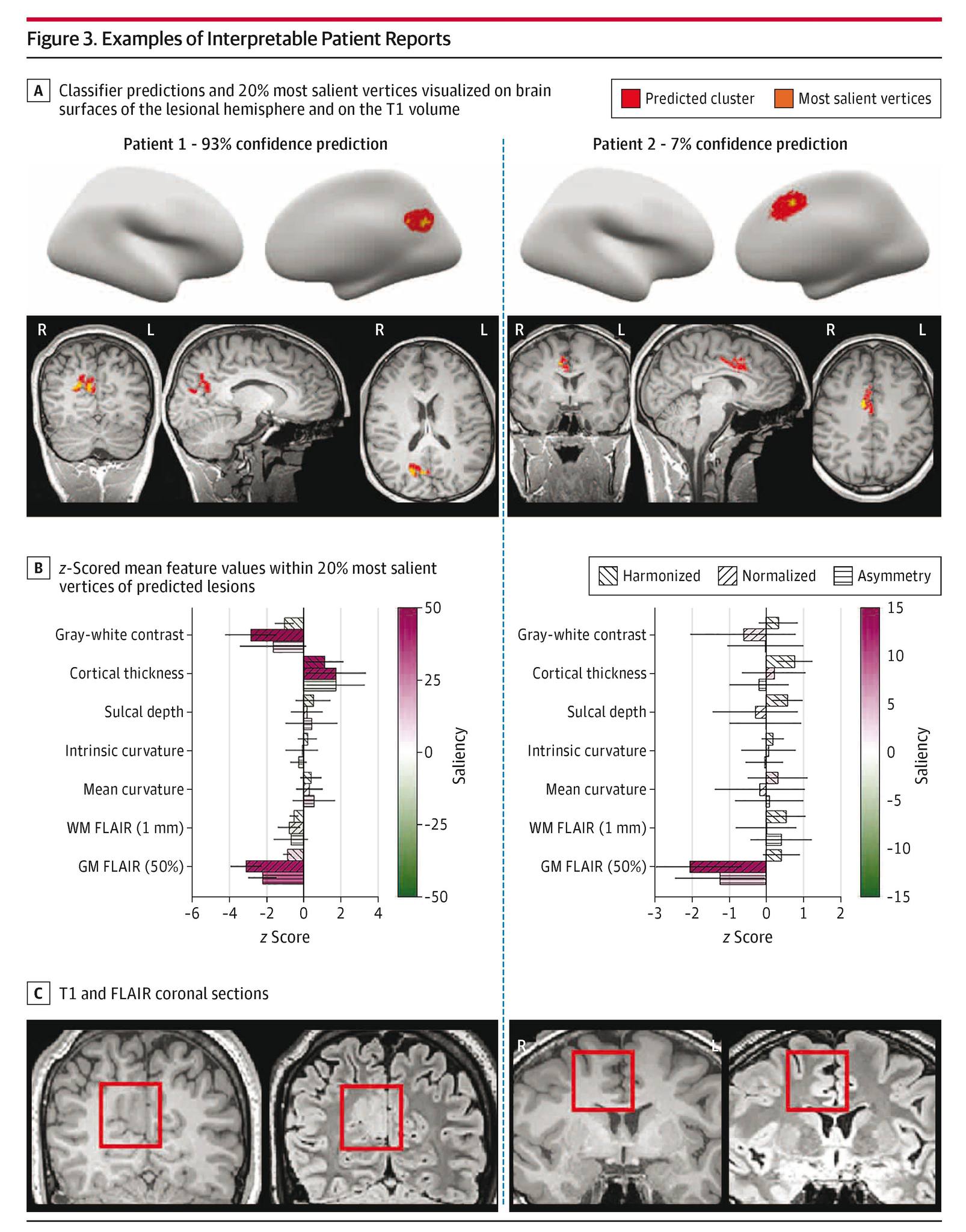 JAMA - The MELD Graph, a graph neural network for detecting focal ...