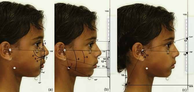 Orthodontics - Photographic assessment of hyperdivergent... | Facebook