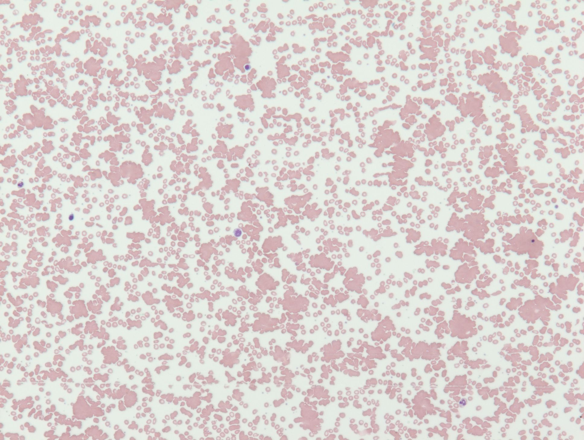 The peripheral smear (50x) shows red... - The Blood Project