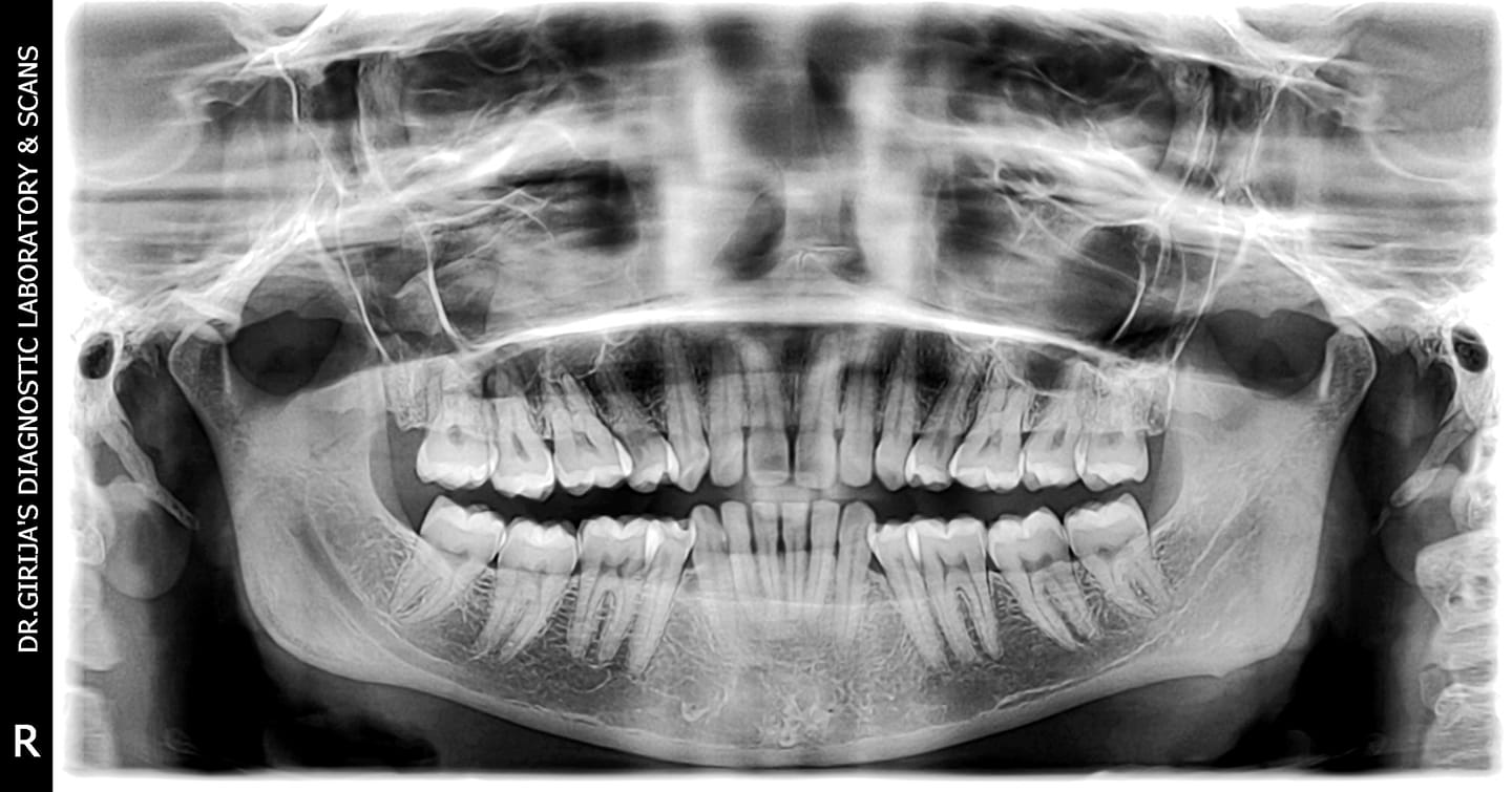 Golden Eyes - OPG - OrthoPantomoGraphy.. Is a #panoramic X-ray of the ...