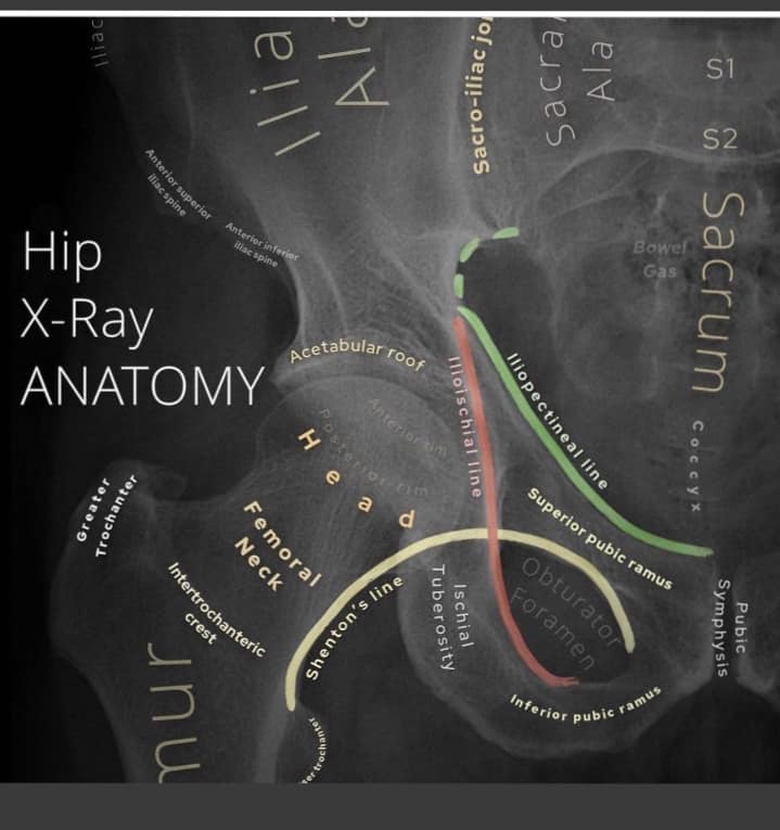 Radioanatomy of the hip... - Radiology Students Of A.M.S | Facebook