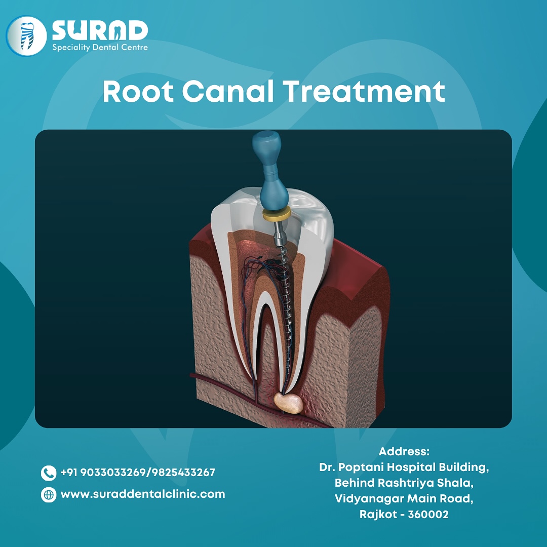 Surad - A root canal treatment is a highly effective dental procedure ...