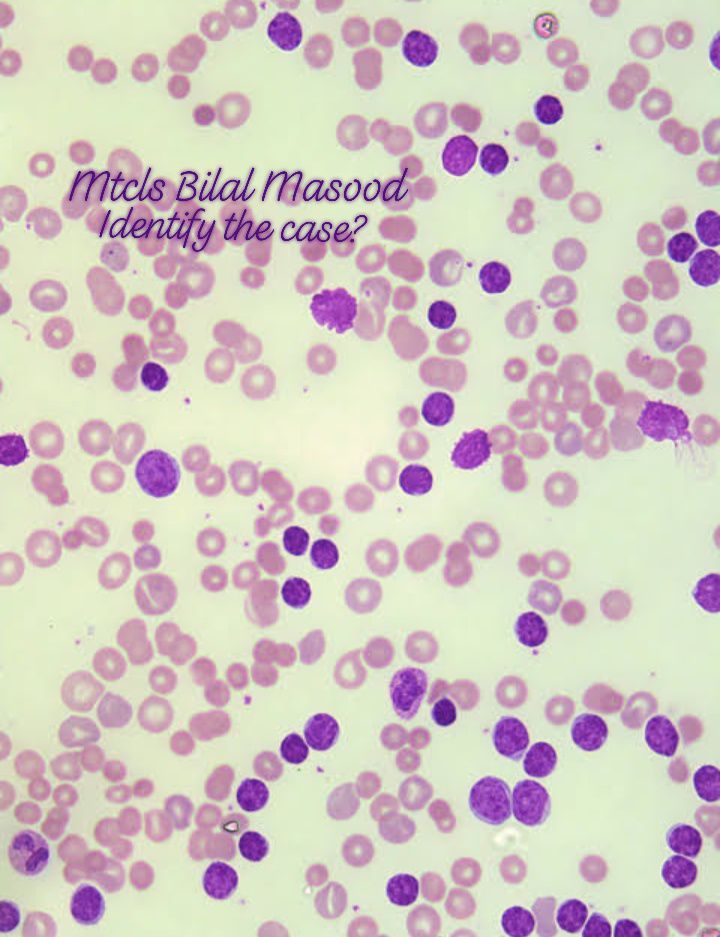 Bilal - A 45-year-old patient presents with a TLC of 33.7 x 10⁹/L and ...