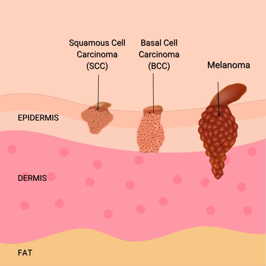 University - 🩺 Not All Skin Cancer is the Same! 🚨 The 3 main types of ...