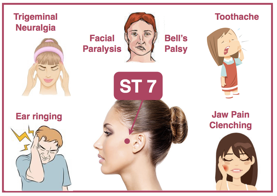 ST 7 is the BEST acupuncture point for trigeminal neuralgia! It's also a great local point for Bell's Palsy, post stroke paralysis, jaw pain & clenching, toothache, and tinnitus. If you enjoyed