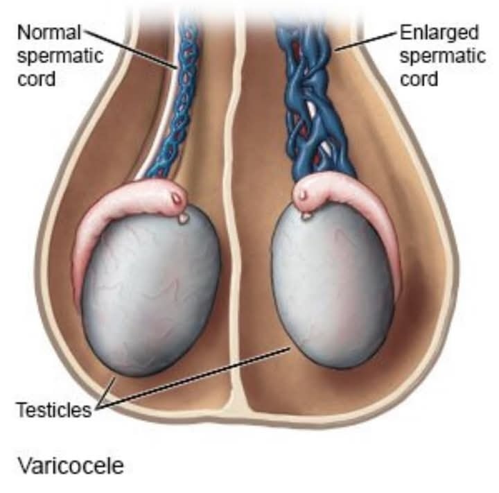 Many men with varicocele are told to completely avoid certain foods but the truth is, managing varicocele isn't about labeling foods as “good” or “bad.” What really matters is how your body