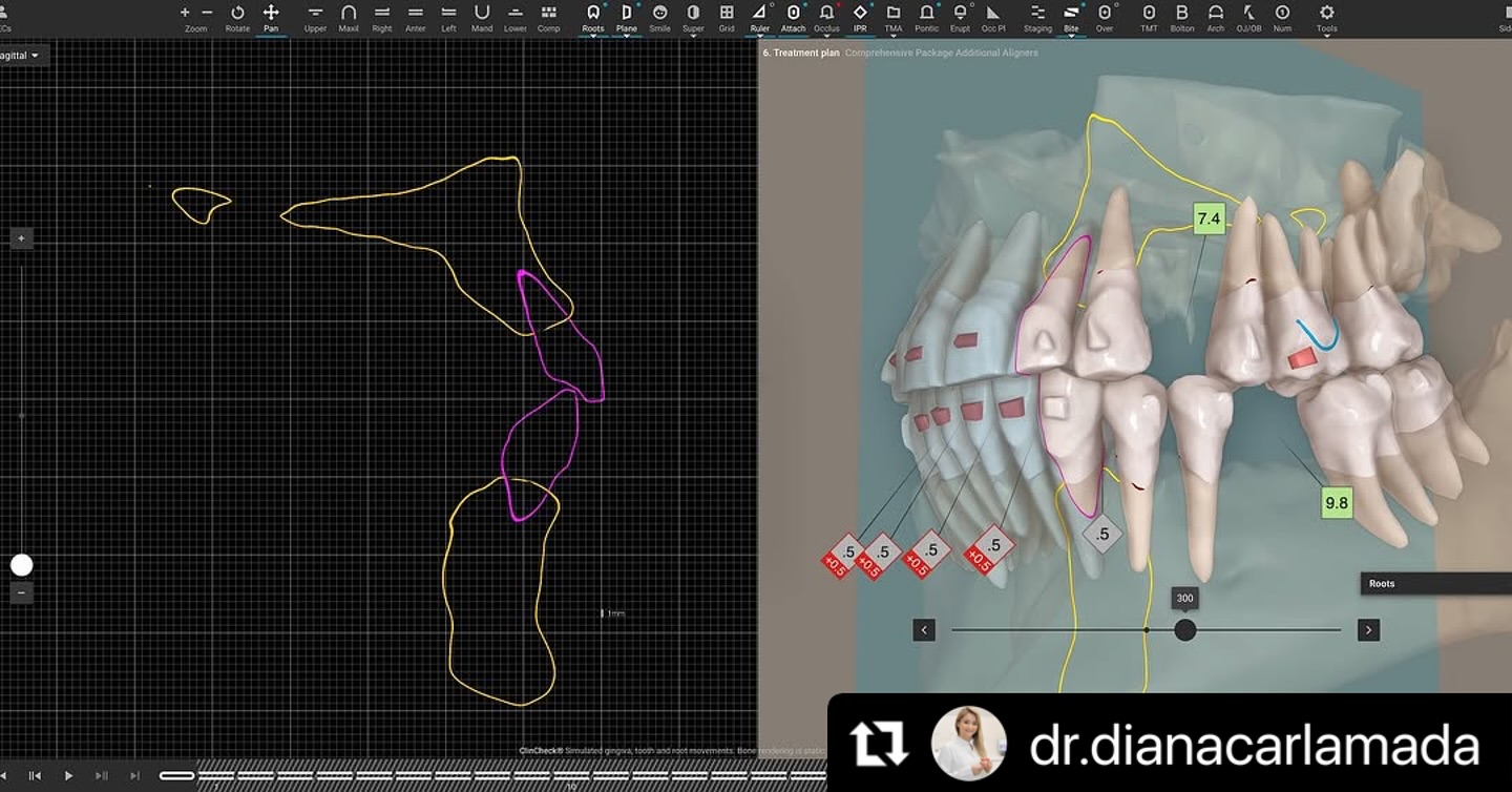 Ortho - How we check the bone-teeth relationship with Invisalign🌈 # ...