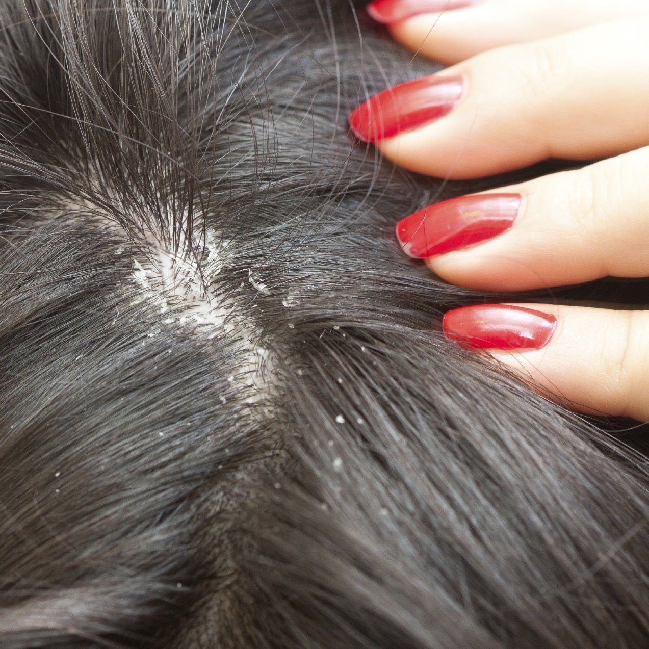 CCMC - The most common underlying reason for dandruff is dry skin ...