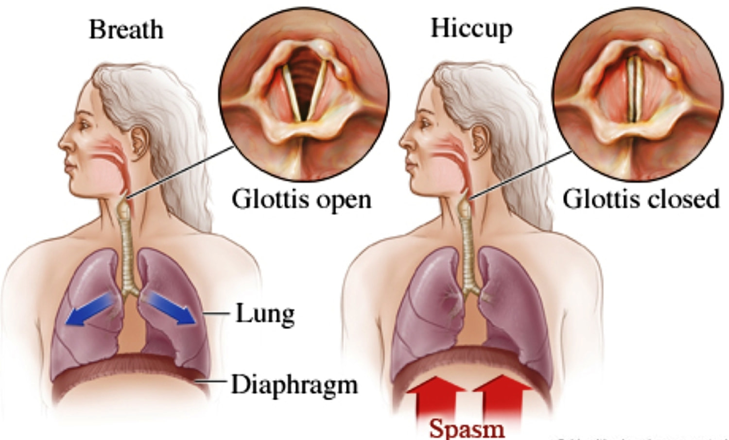 Does Mounjaro cause hiccups?