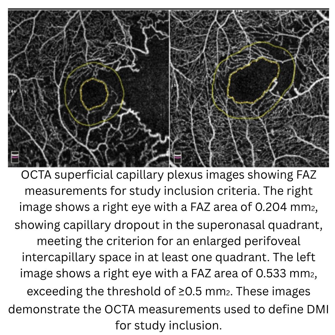 Retina - THE SUPERFICIAL CAPILLARY PLEXUS PERIVASCULAR... | Facebook