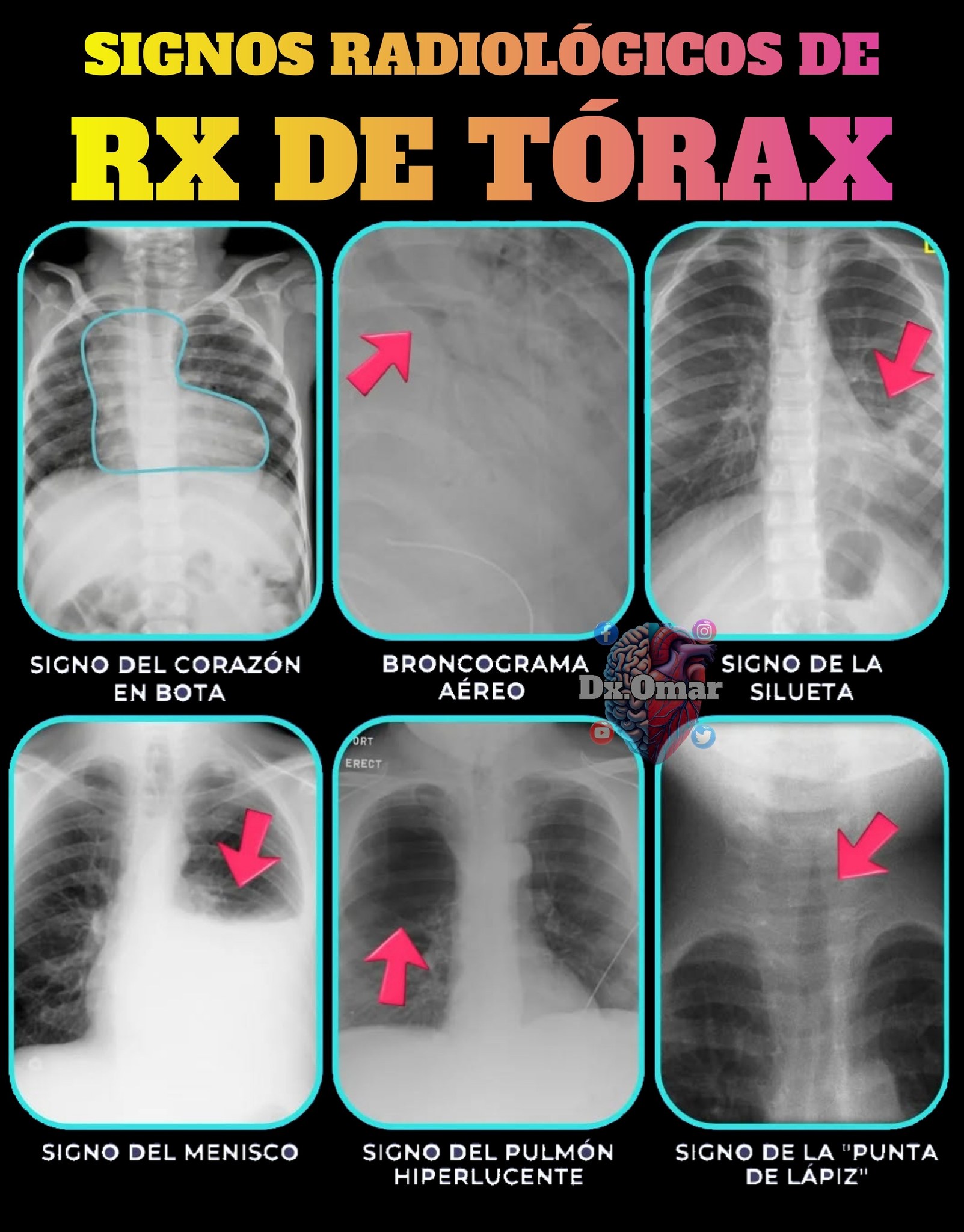 Dx. - 🚨☢️Signos radiológicos de una Rx de tórax 🧑‍⚕️🏥 | Facebook
