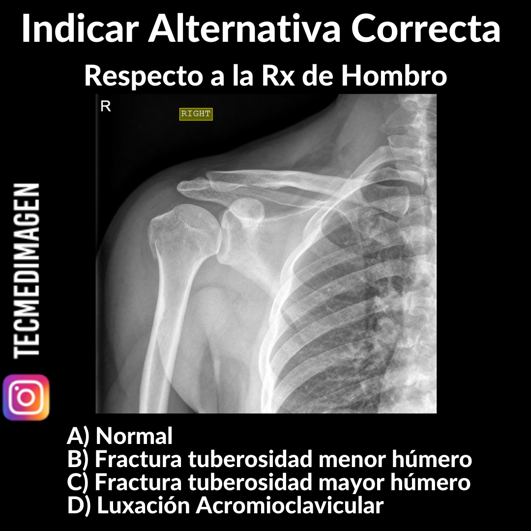 Anatomía De Rayos X Del Húmero Anatomía Radiológica: Rayos X, TAC,
