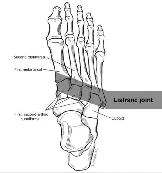 All - ‼️Lisfranc Injury: A Serious Foot Condition You Shouldn’t Ignore‼ ...
