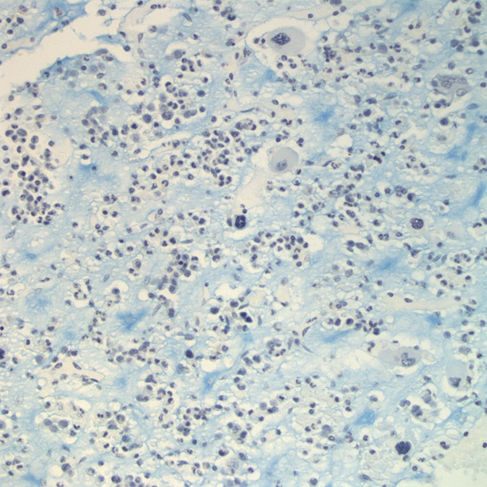 Histologic images of gelatinous transformation of bone marrow from a ...