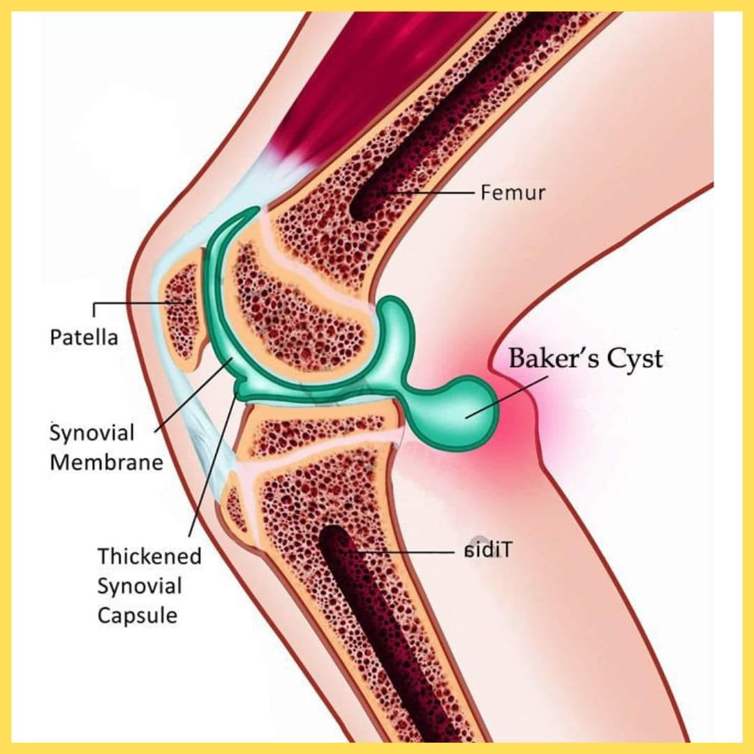 zf-introduction-a-baker-cyst-is-a-fluid-filled-growth-behind-the