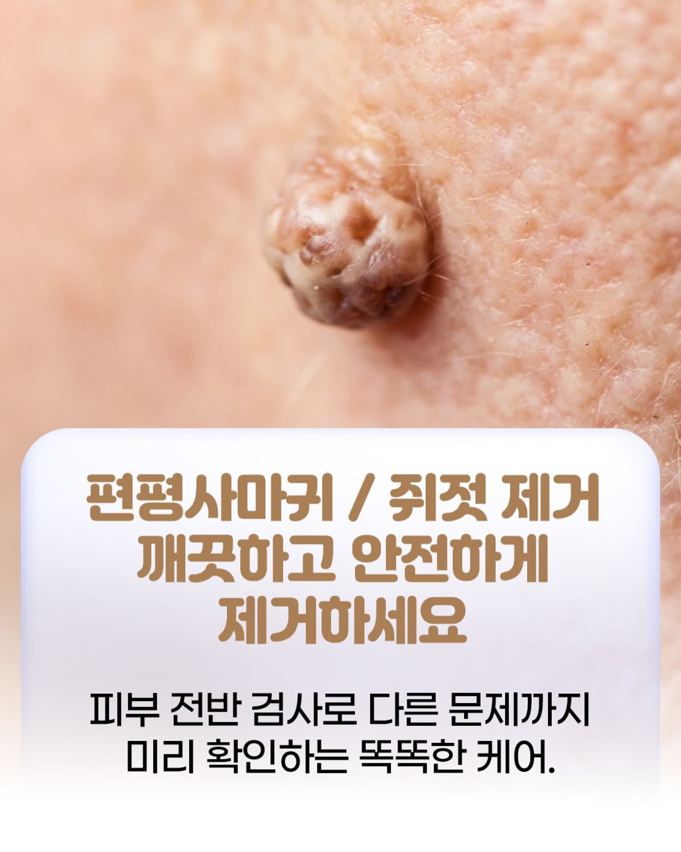 진주 - 편평사마귀와 쥐젓은 대개 통증을 심하게 유발하지는 않지만, 미용적 문제나 생활 속 불편함을 유발할 수 있습니다. 또한 ...