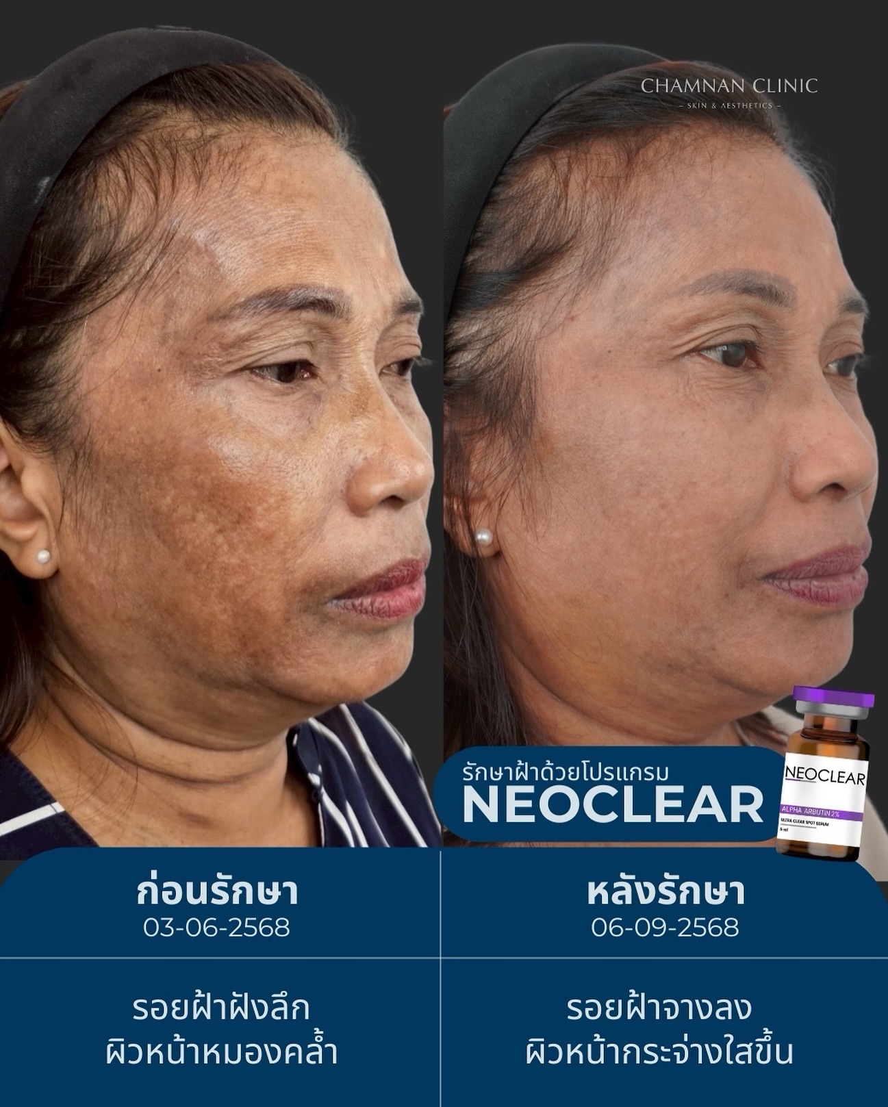 Chamnan - “จากรอยฝ้าฝังลึก สู่ผิวกระจ่างใสขึ้นจริง” ผลลัพธ์หลังทำ ...
