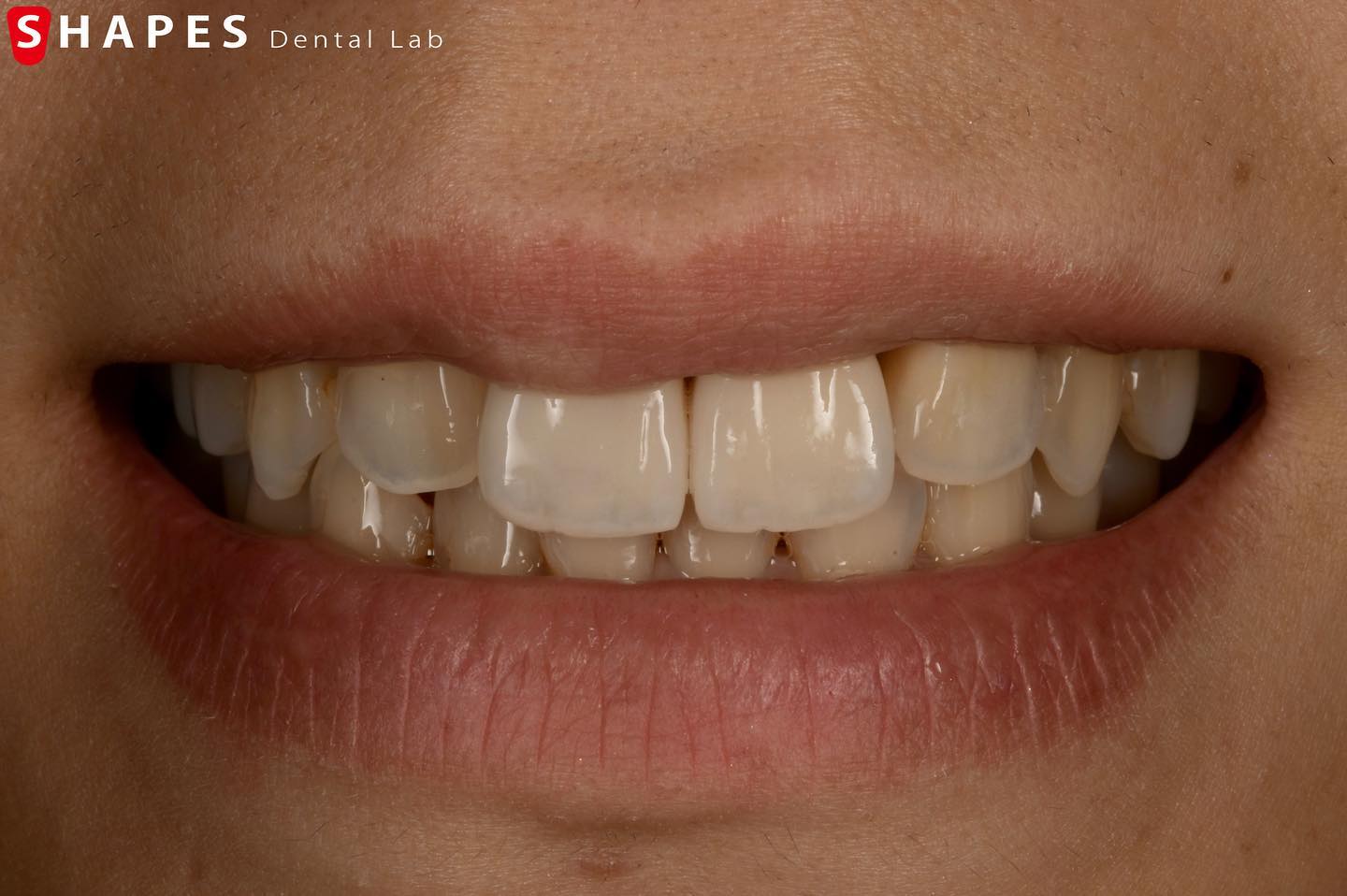 e.max Press＋emax... - Shapes Dental Lab シェイプスデンタルラボ 静岡県