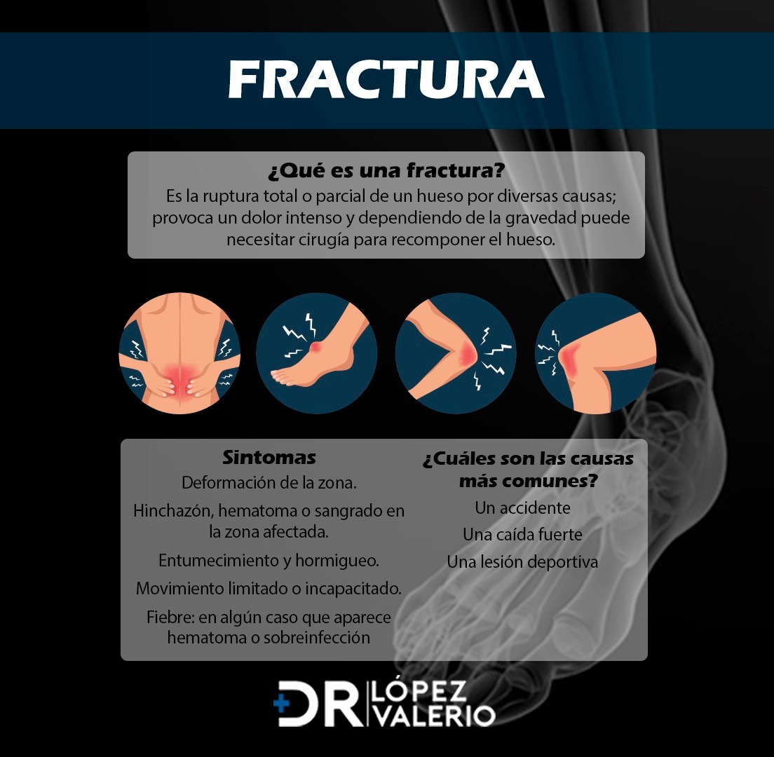¿Sabes qué es una fractura? 🤔 • Pueden ocurrir por accidentes, lesiones ...