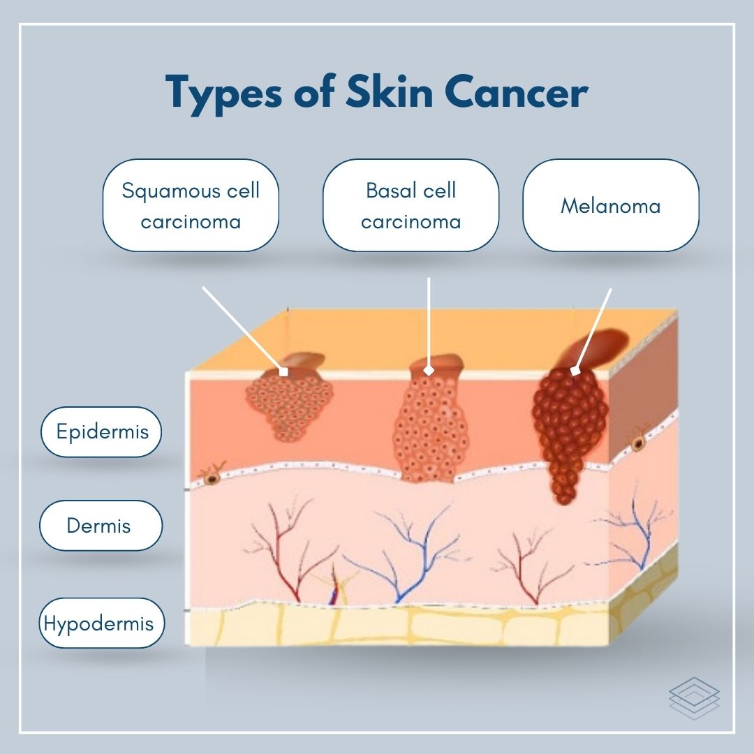 The most common type of cell... - Everything Skin Clinic
