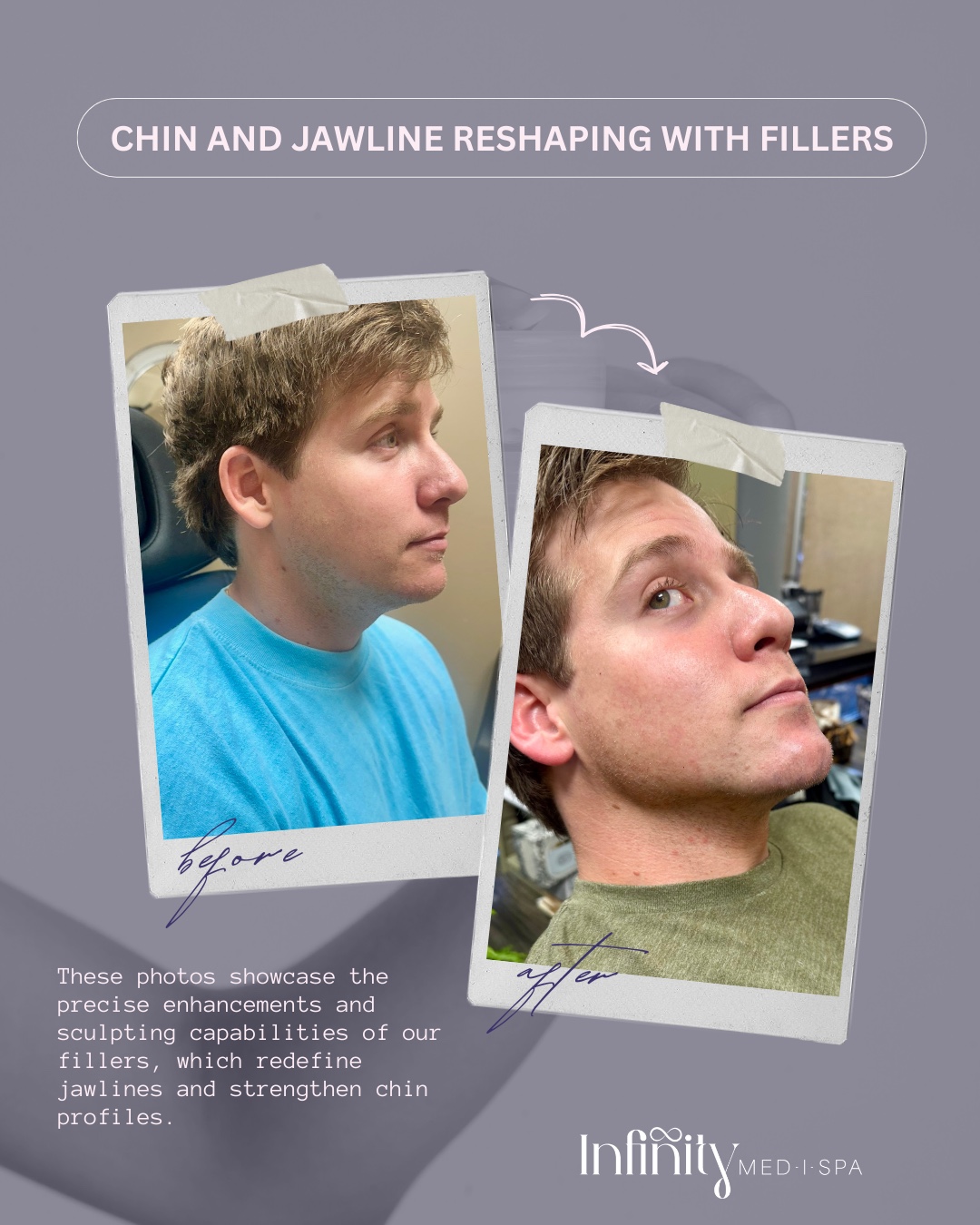 Infinity - Celebrate Dad with a Stronger, More Defined Look 💪 Jawline ...