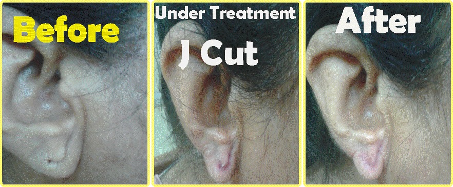 Ear Lobe Repairing | Facebook