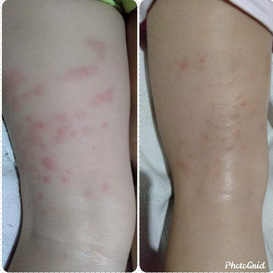 Skin rashes ba ang prolema? Ito po... - Skyler’s Essentials