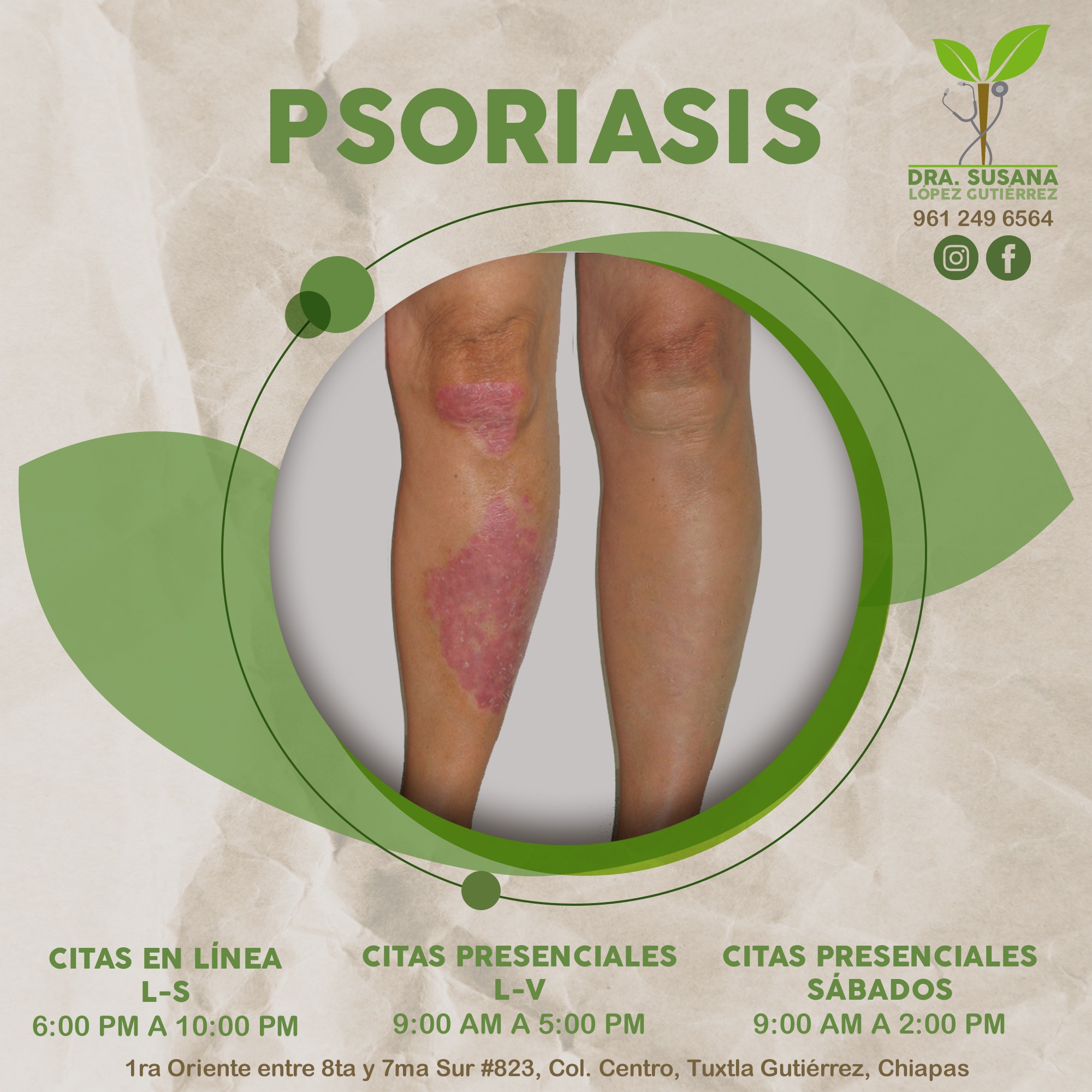 Dra. Susana López Gutiérrez - La psoriasis es una enfermedad de la piel ...