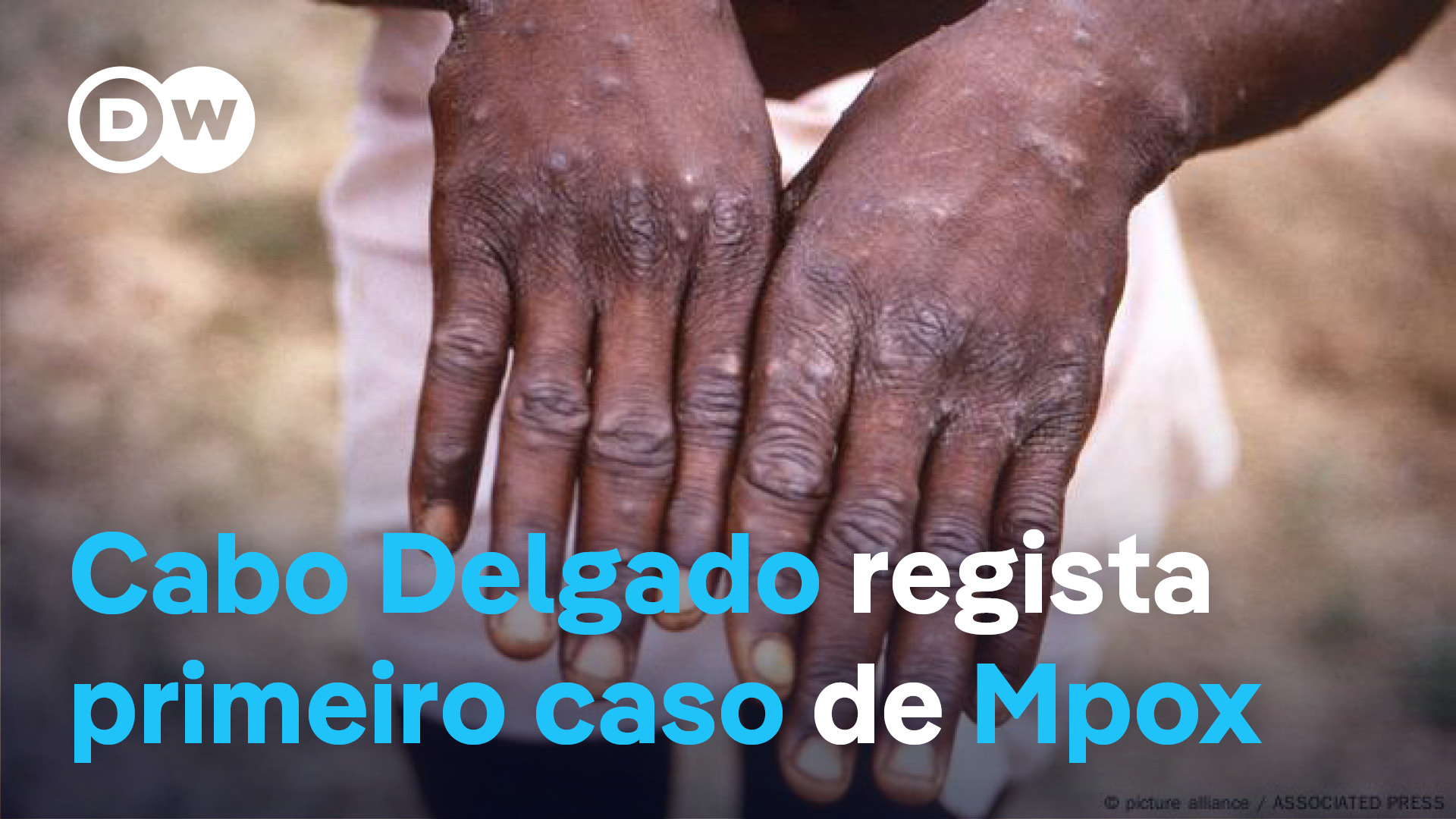 Mpox: Cabo Delgado regista... - DW Português para África | Facebook