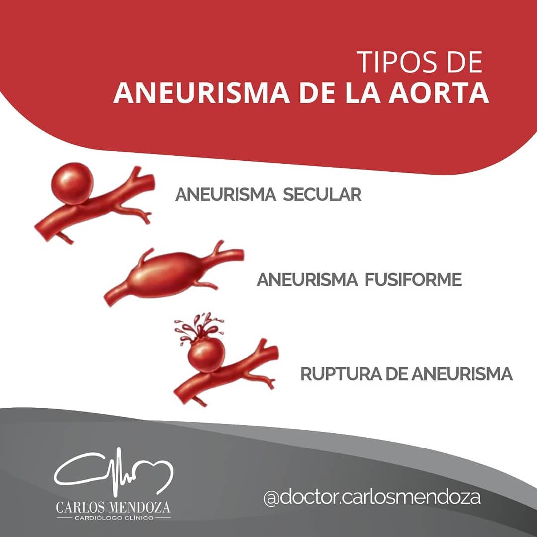 Un Aneurisma de Aorta... - Dr. Carlos Mendoza Cardiólogo