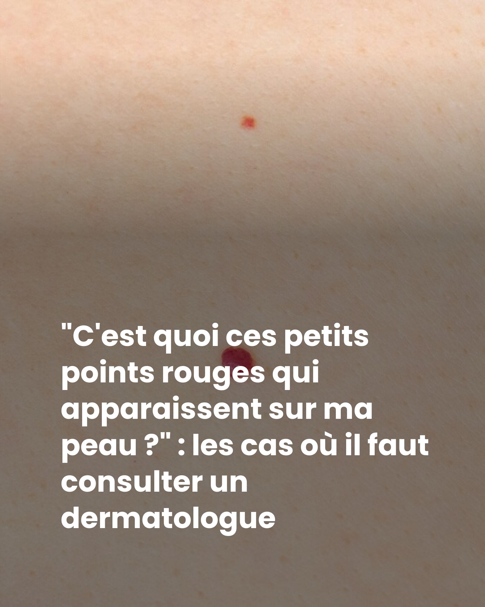 bestie, - Petits points rouges ? Inoffensif ou inquiétant ? 🧐 | Facebook