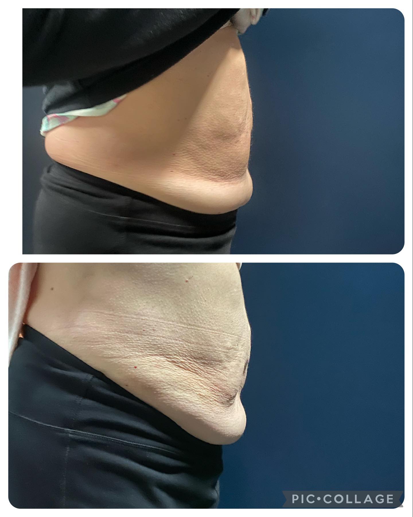 SoDel - 🔥 FREEZE FAT in Just 5 Minutes! 🔥 Say goodbye to stubborn fat ...