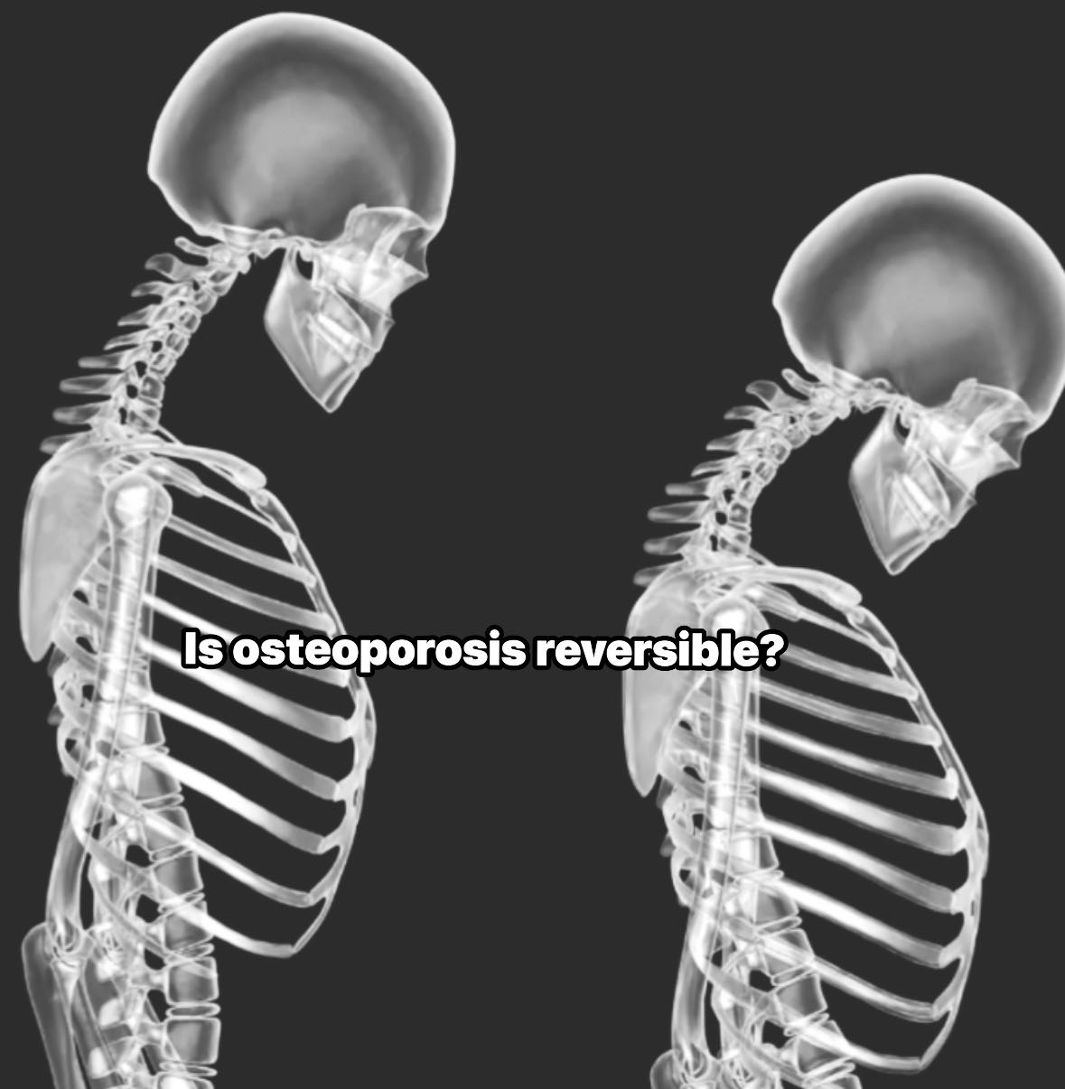 Doc - Osteoporosis is a bone disease causing weak, brittle bones ...