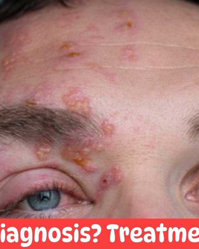 Medical - A 52-year-old immunocompromised male presents with acute ...