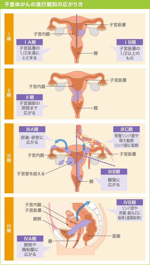 子宮癌（頸癌）情報館 - 子宮体癌の進行期 子宮体癌が体内でどのような