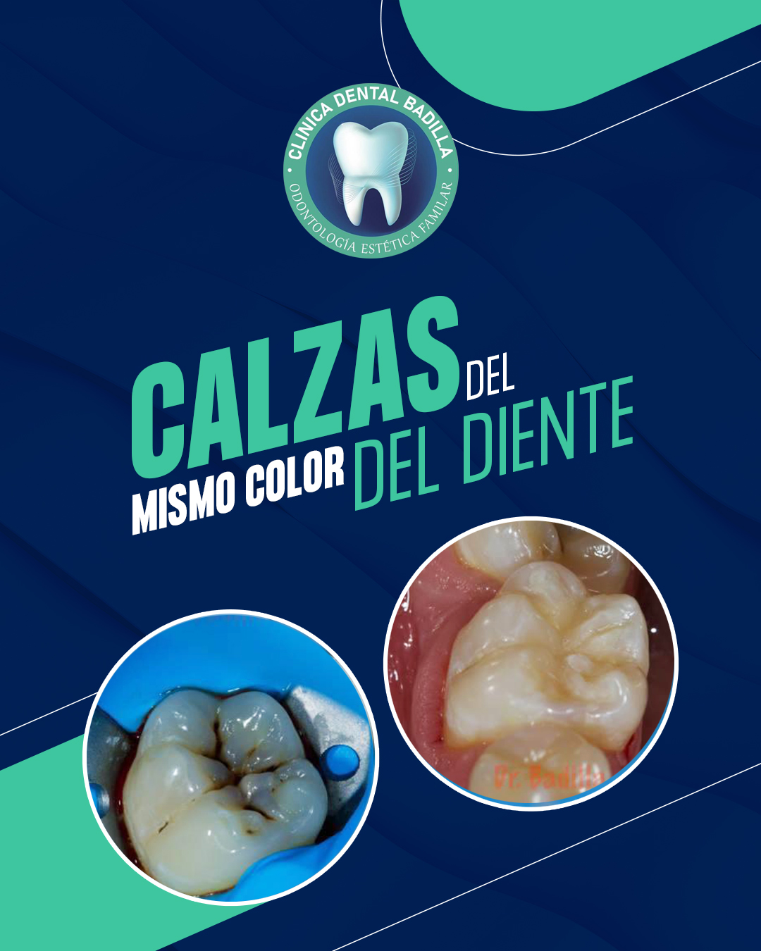 Clinica Dental Badilla . - 😯 La resina dental se utiliza para ...