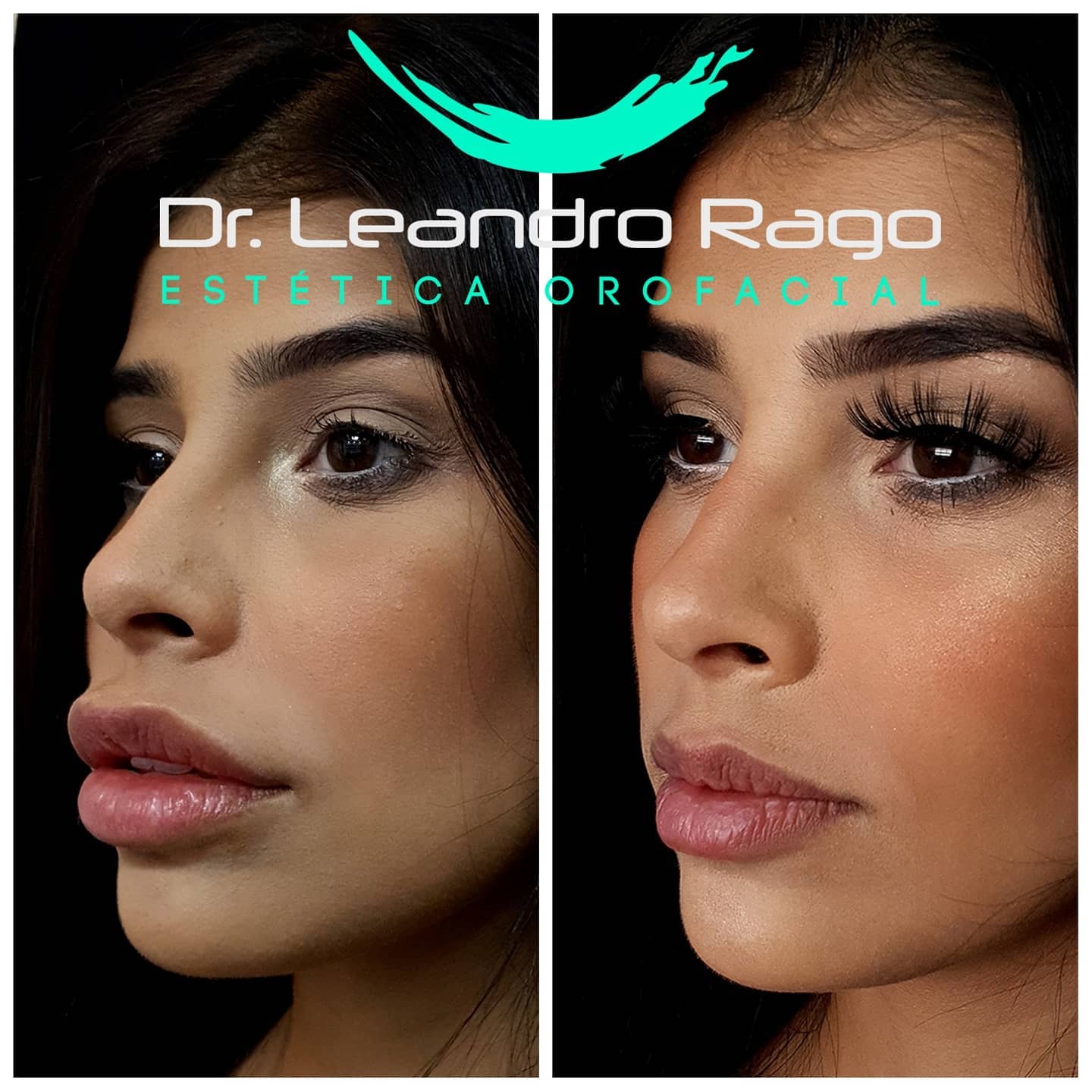💥Antes e Depois dos lábios da... - Instituto Dr. Leandro Rago | Facebook