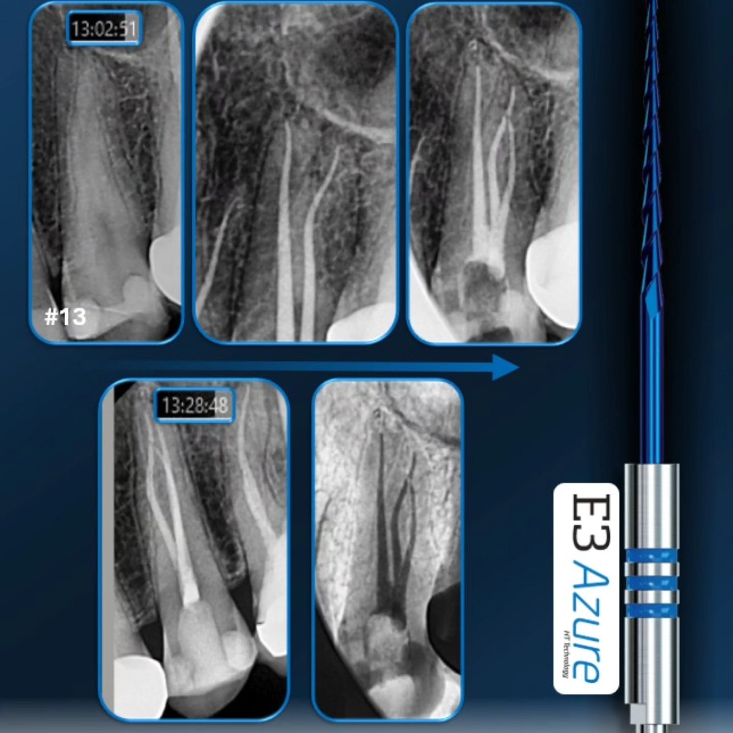 Timeless - 🦷 Three Roots. One Premolar. 26 Minutes. Precision meets ...