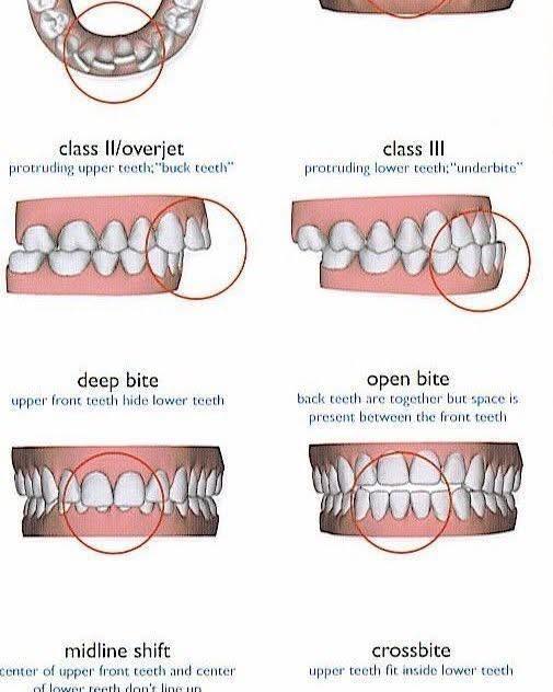 Emeryville - Different types of malocclusions, their advantages and ...
