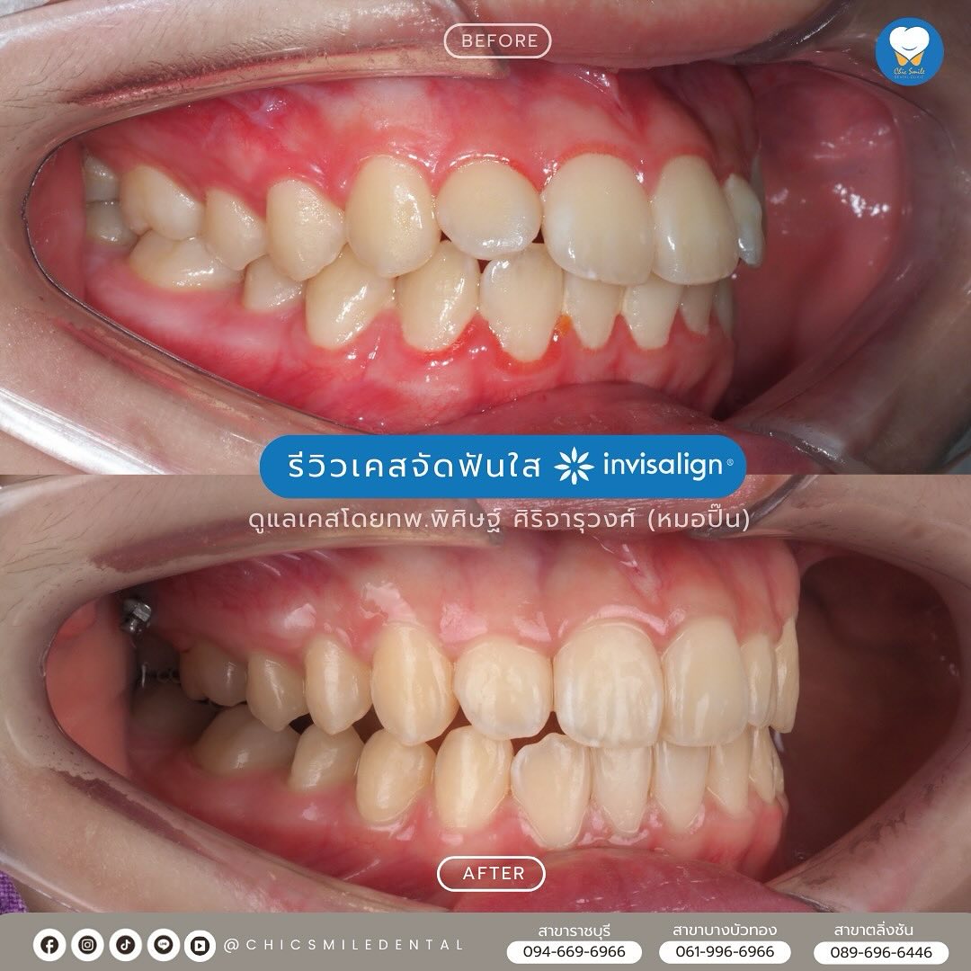เครื่อง VPro5 คืออะไร? —— เป็นเครื่องมือพิเศษ ช่วยให้ #invisalign แนบ ...