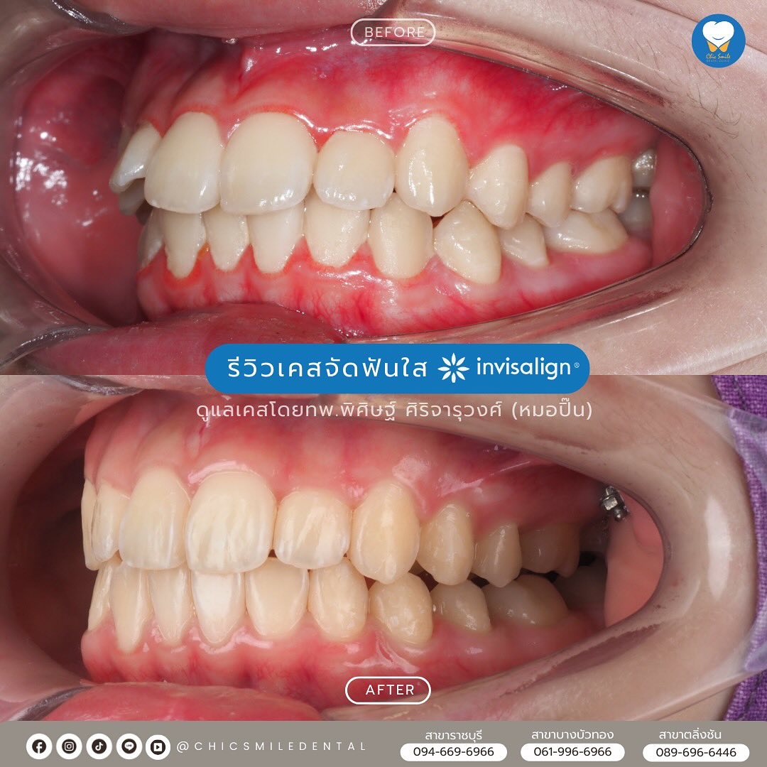เครื่อง VPro5 คืออะไร? —— เป็นเครื่องมือพิเศษ ช่วยให้ #invisalign แนบ ...