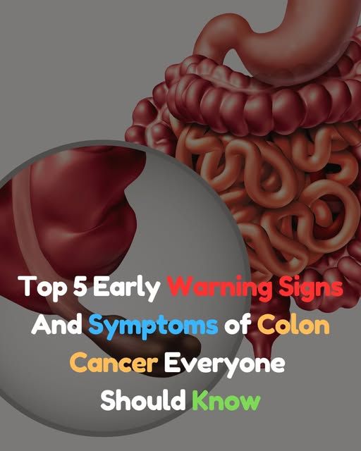 Colorectal cancer is a type of cancer... - Best Folk Medicine | Facebook
