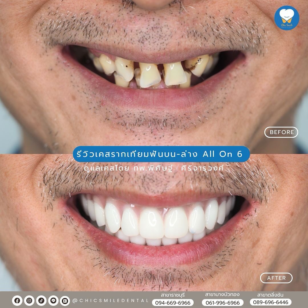 เครื่อง VPro5 คืออะไร? —— เป็นเครื่องมือพิเศษ ช่วยให้ #invisalign แนบ ...